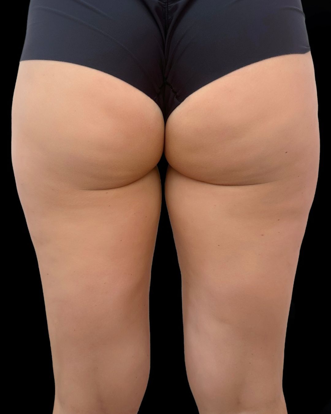 Glutei e gambe dopo la carbossiterapia