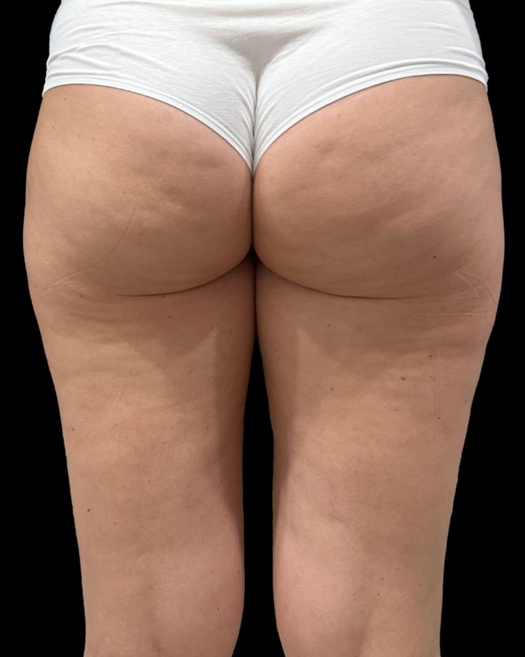 Glutei e gambe prima della carbossiterapia