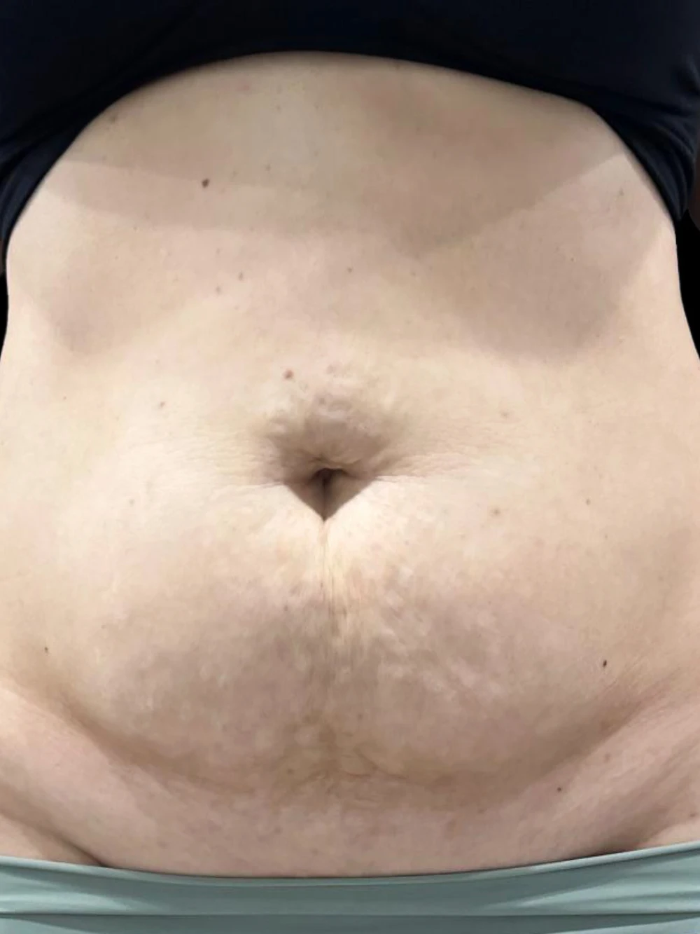 Foto frontale dell'addome della paziente prima del trattamento LESC.