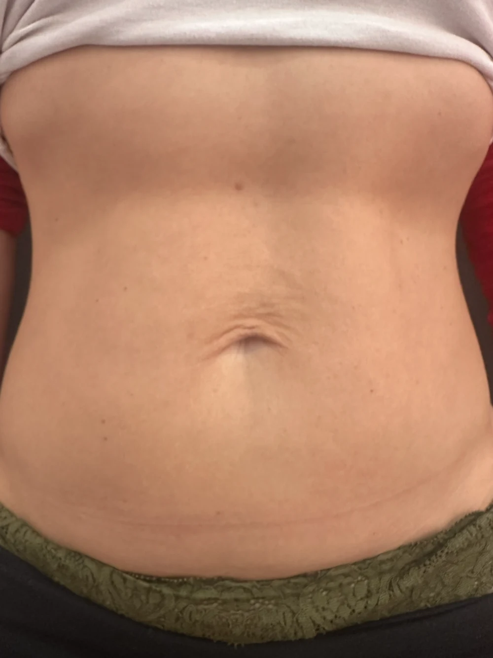 Paziente dopo il trattamento acido polilattico all'addome.