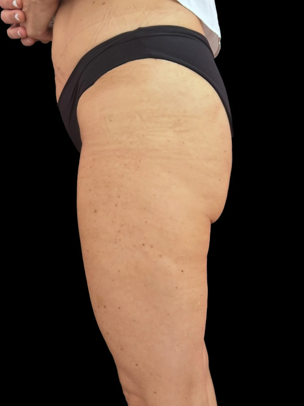 Gambe del paziente dopo il trattamento di acido polilattico.