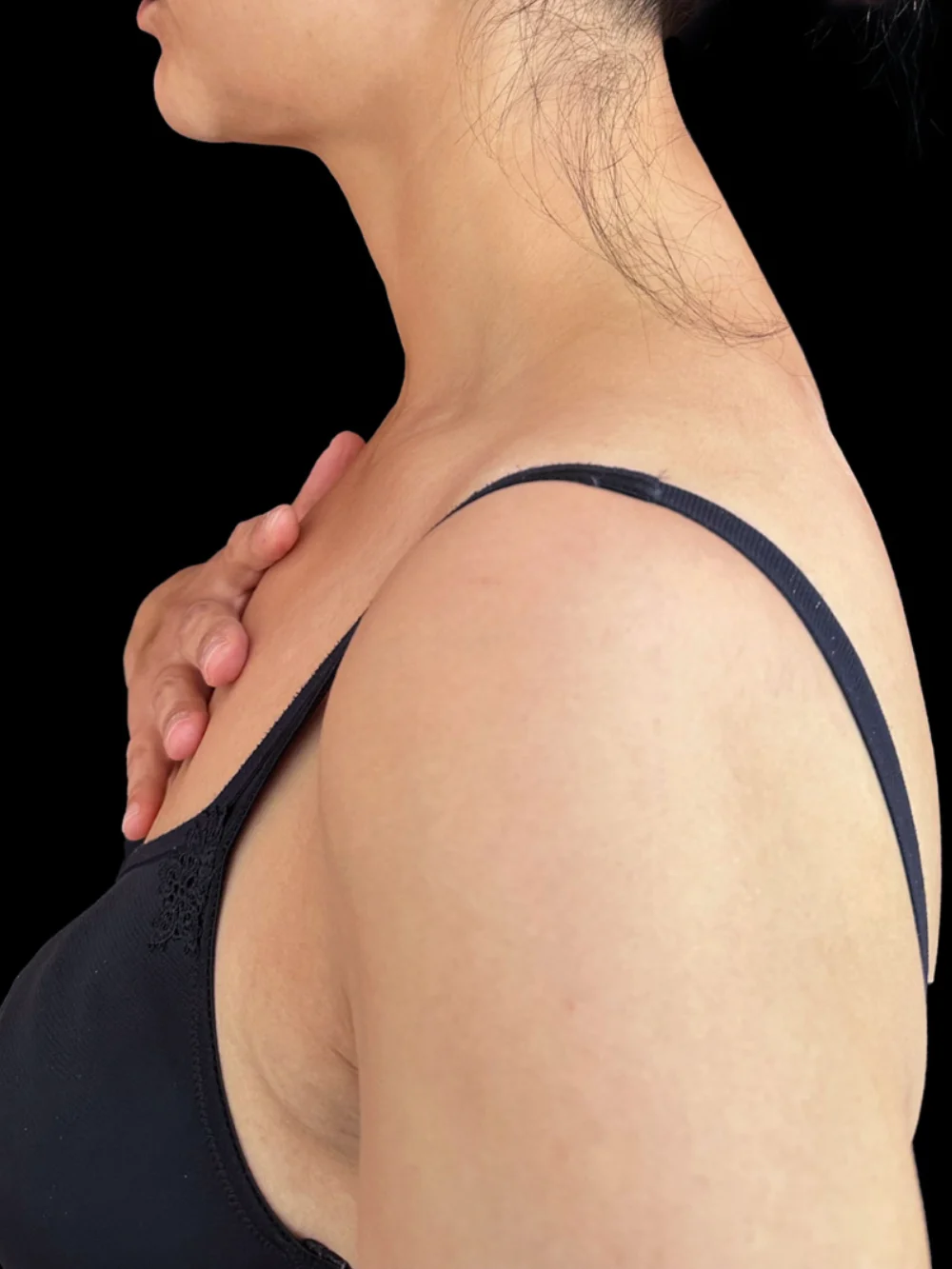 Paziente dopo il trattamento di Lesc al gibbo del collo.