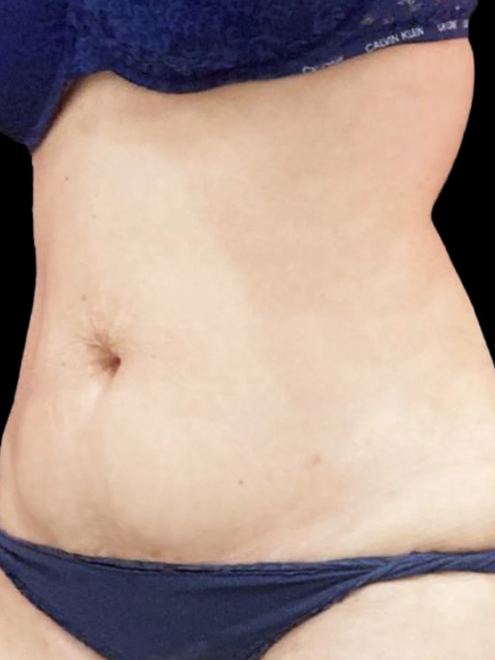 Addome della paziente dopo il trattamento di LESC.