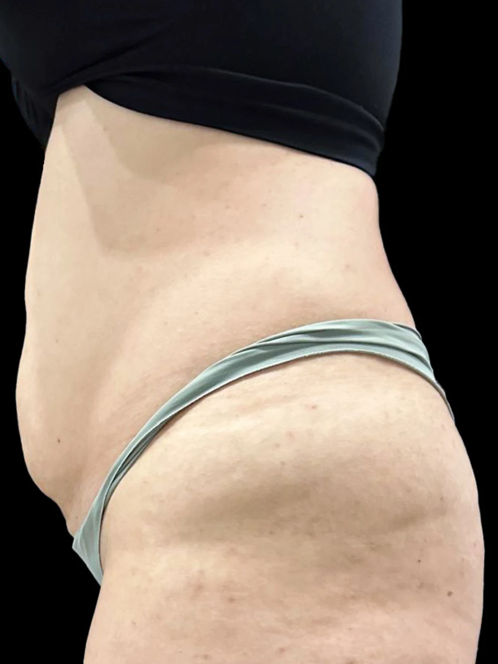 Foto della paziente sul fianco sinistro prima del trattamento LESC.