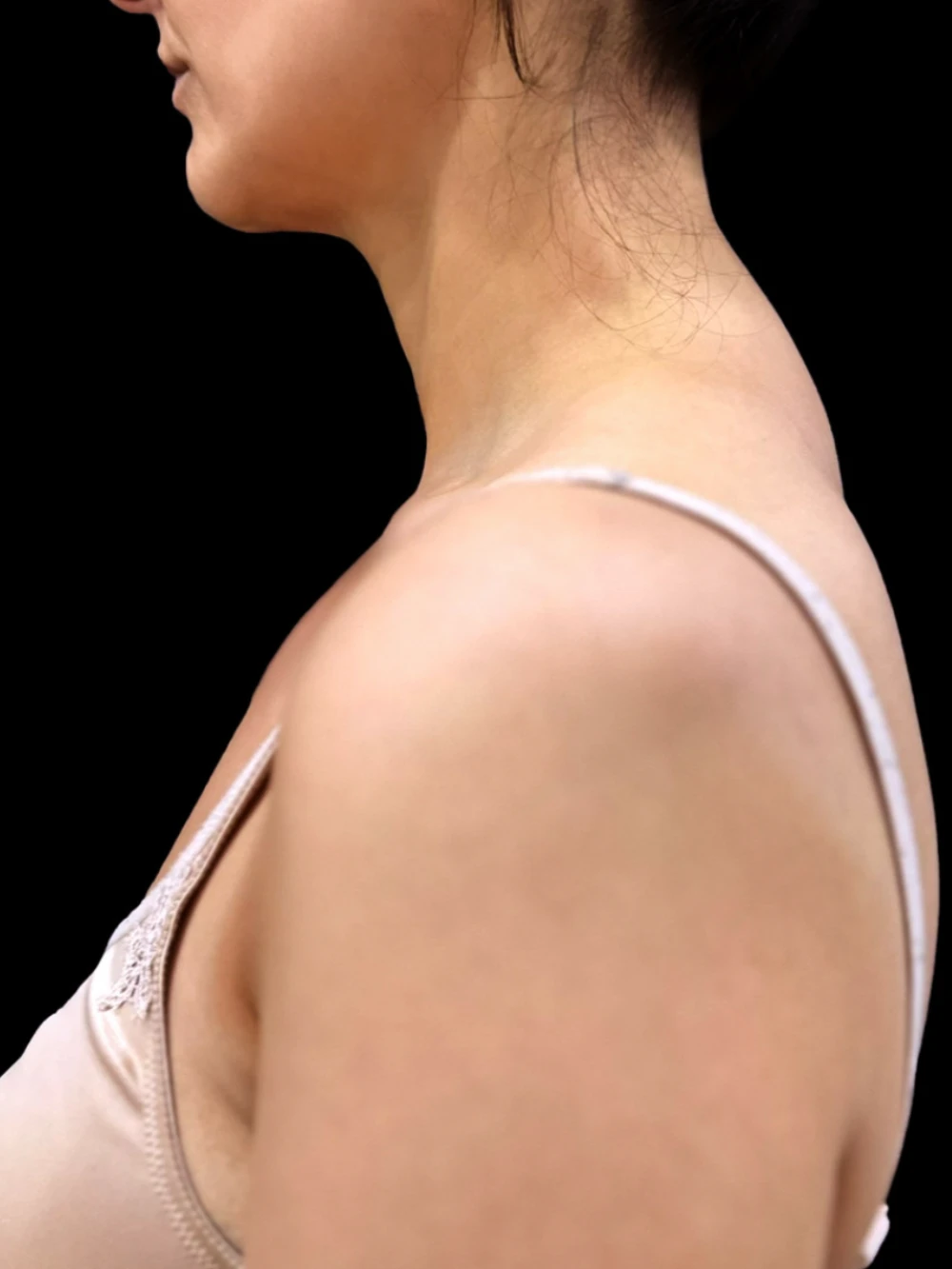 Paziente prima del trattamento di LESC al gibbo del collo.