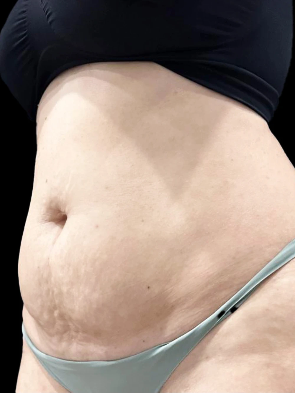 Addome della paziente prima di effettuare il trattamento di LESC.