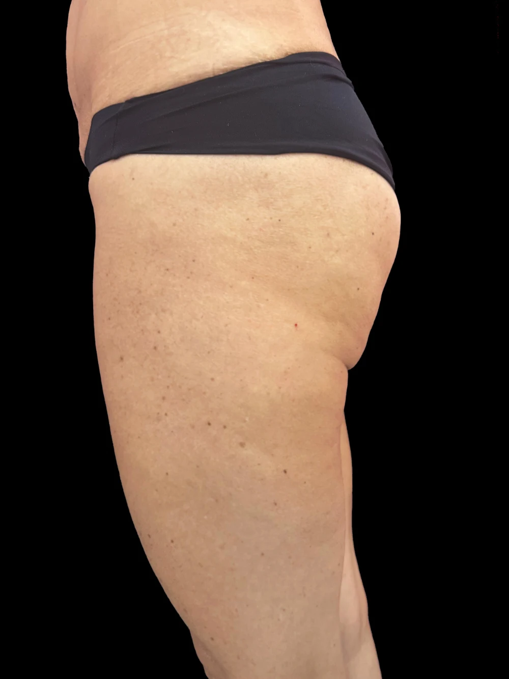 Gambe del paziente prima del trattamento di acido polilattico.