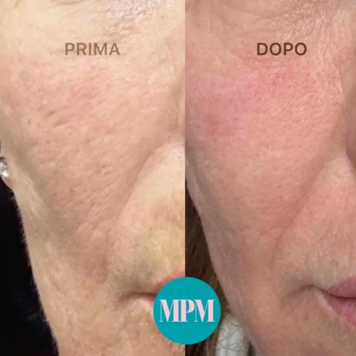 Prima e dopo laser CO2 frazionato su rughe