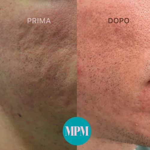 Prima e dopo laser CO2 frazionato su segni da acne