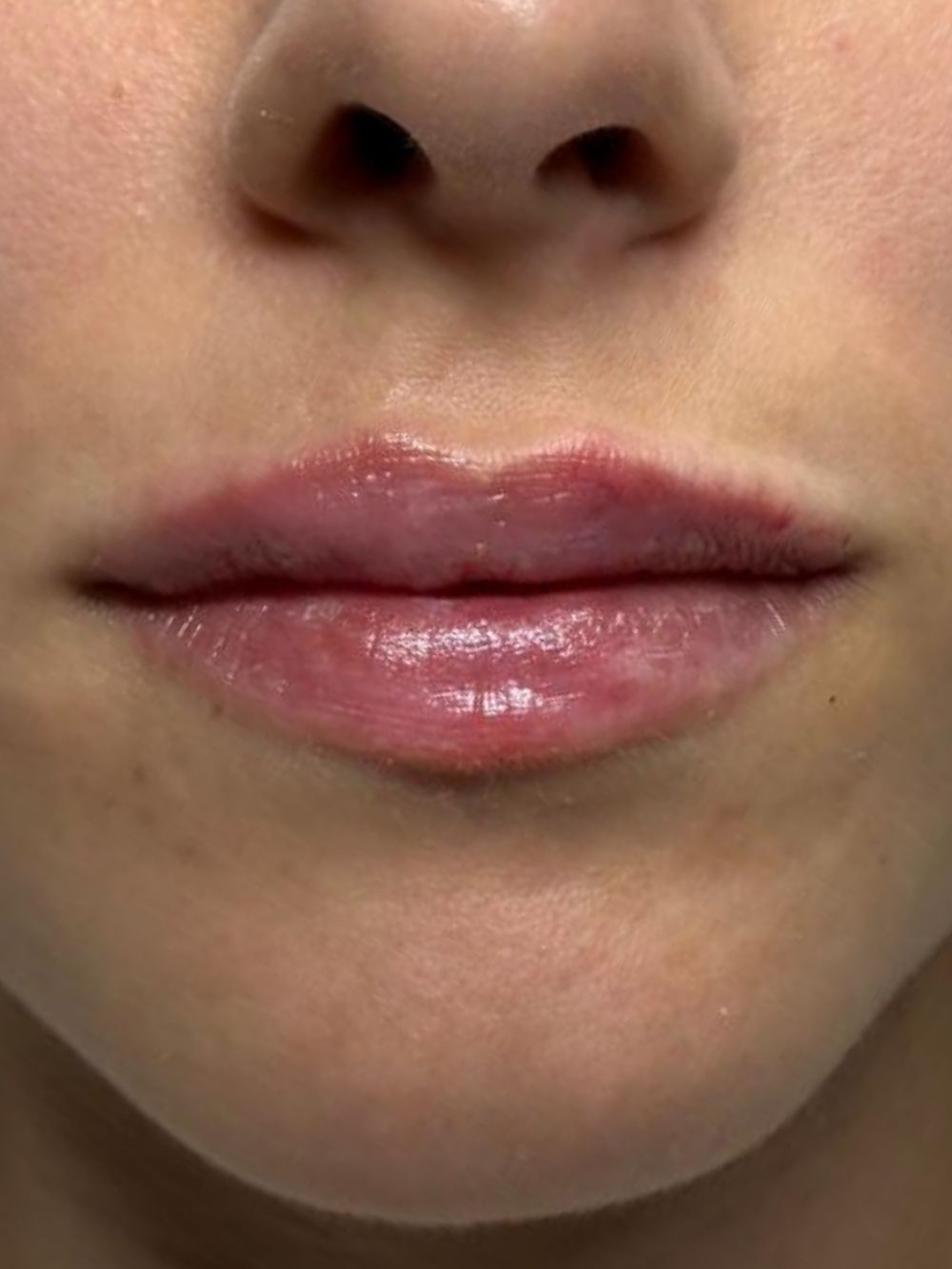 Bocca di una paziente dopo il filler labbra