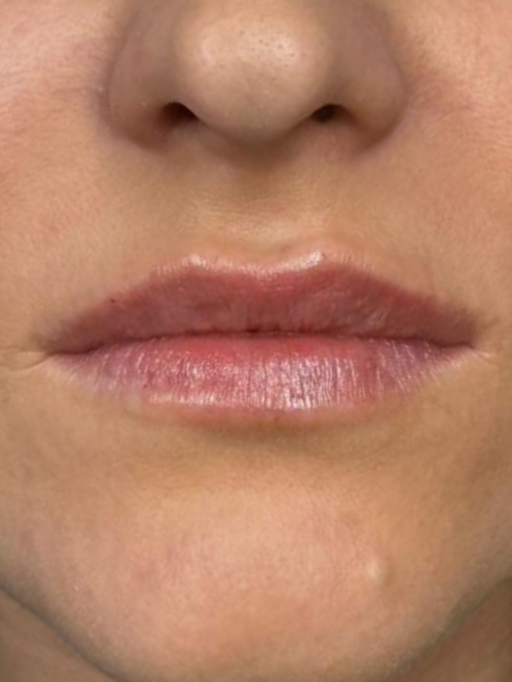 Paziente dopo un trattamento filler labbra