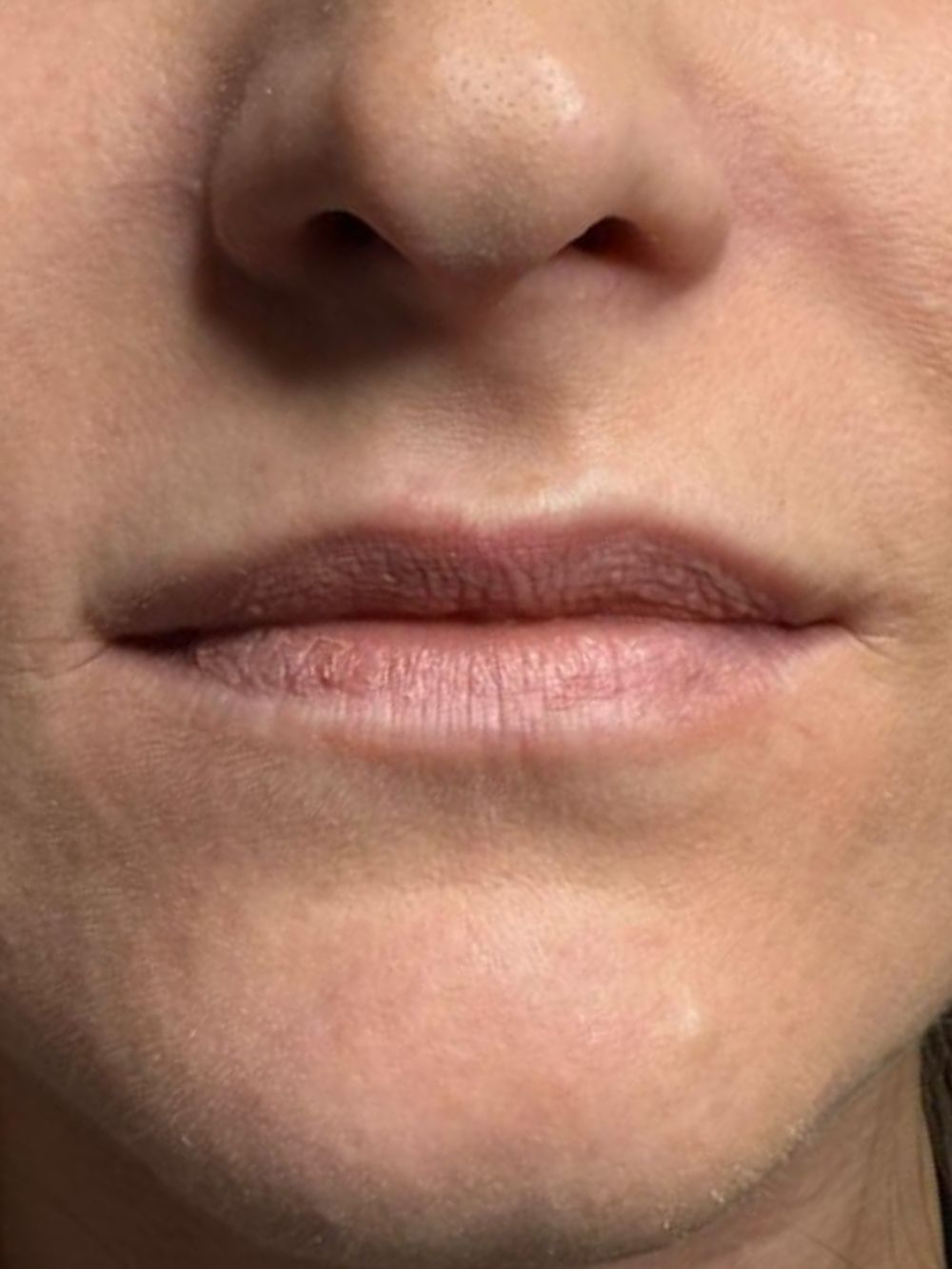 Paziente prima di un trattamento filler labbra