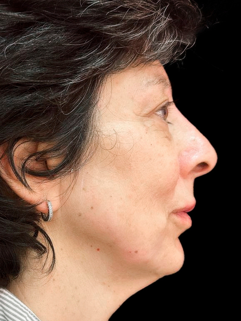 Acido polilattico, filler labbra e botox dopo