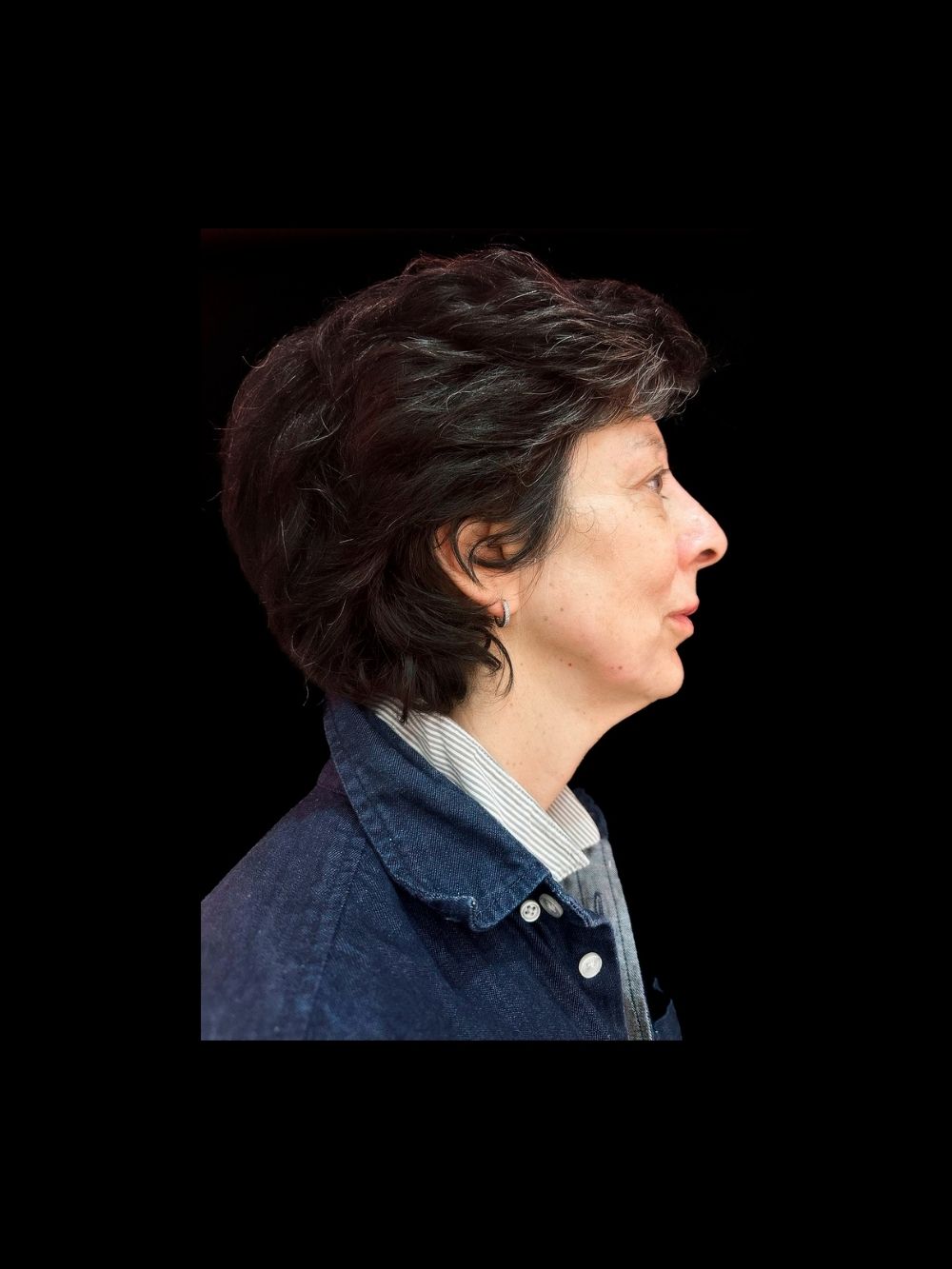 Acido polilattico, filler labbra e botox dopo
