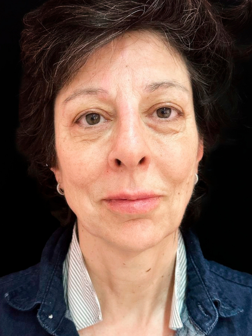 Acido polilattico e filler labbra e botox dopo