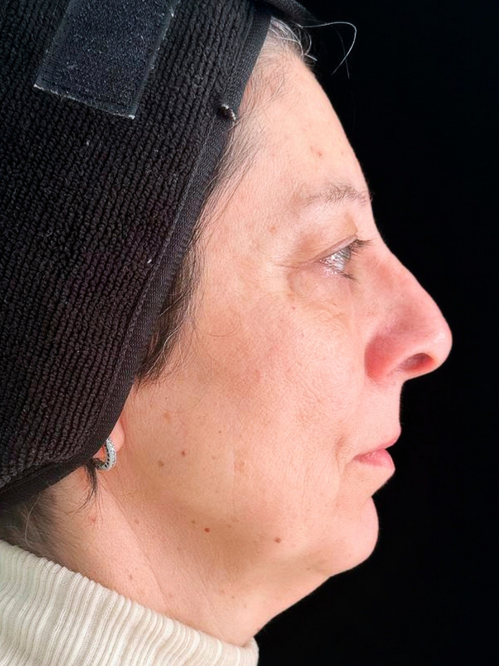 Acido polilattico, filler labbra e botox prima