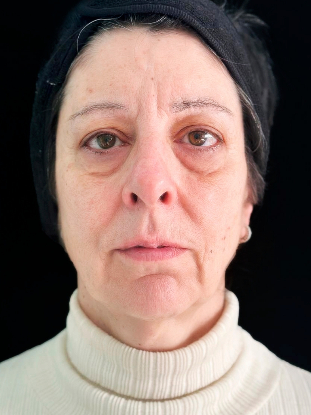 Acido polilattico, filler labbra e botox prima