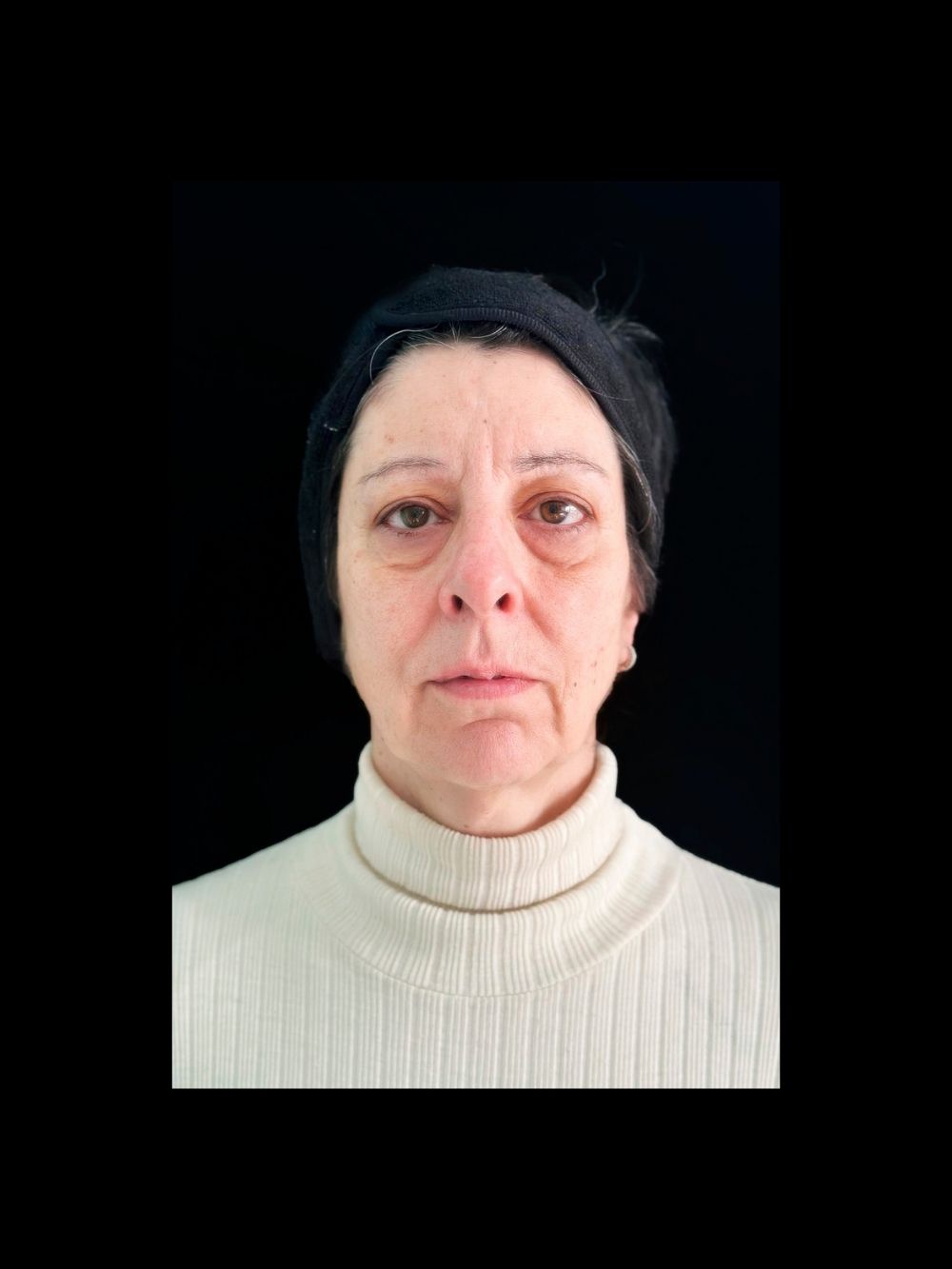 Acido polilattico, filler labbra e botox prima