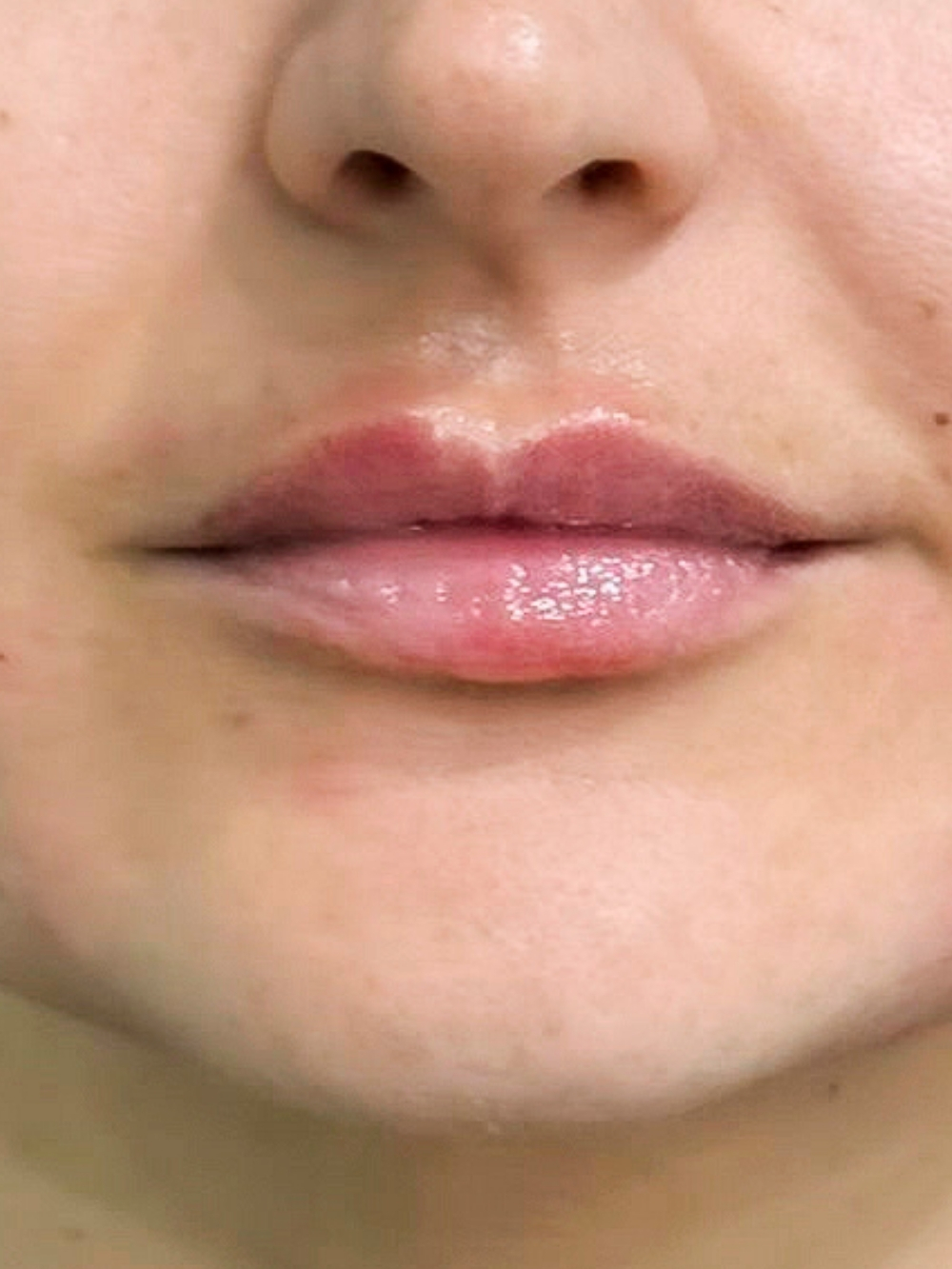 Filler labbra dopo