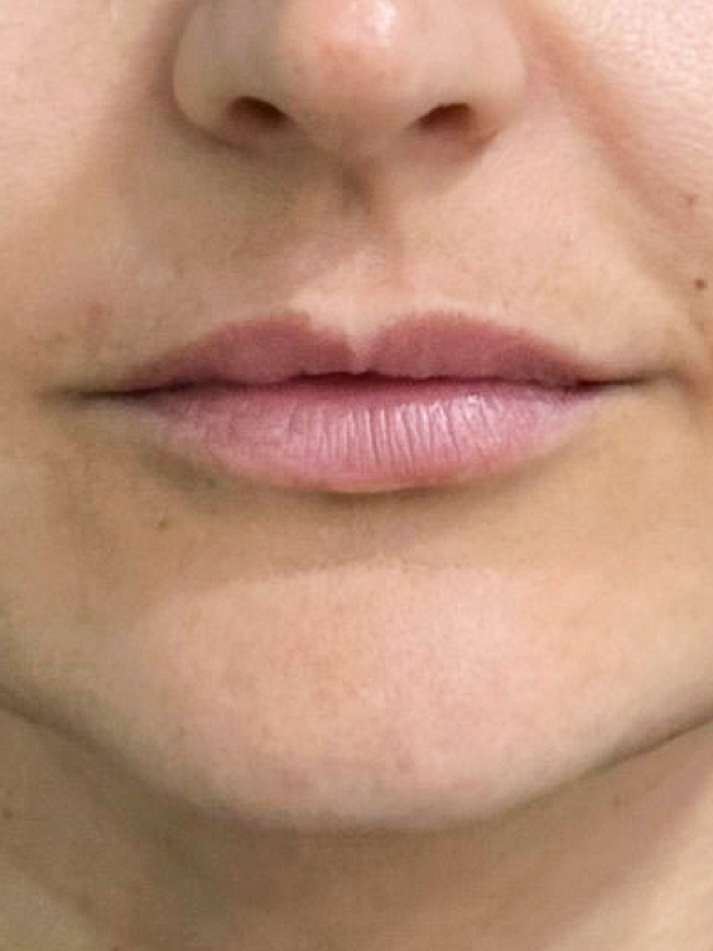 Filler labbra prima