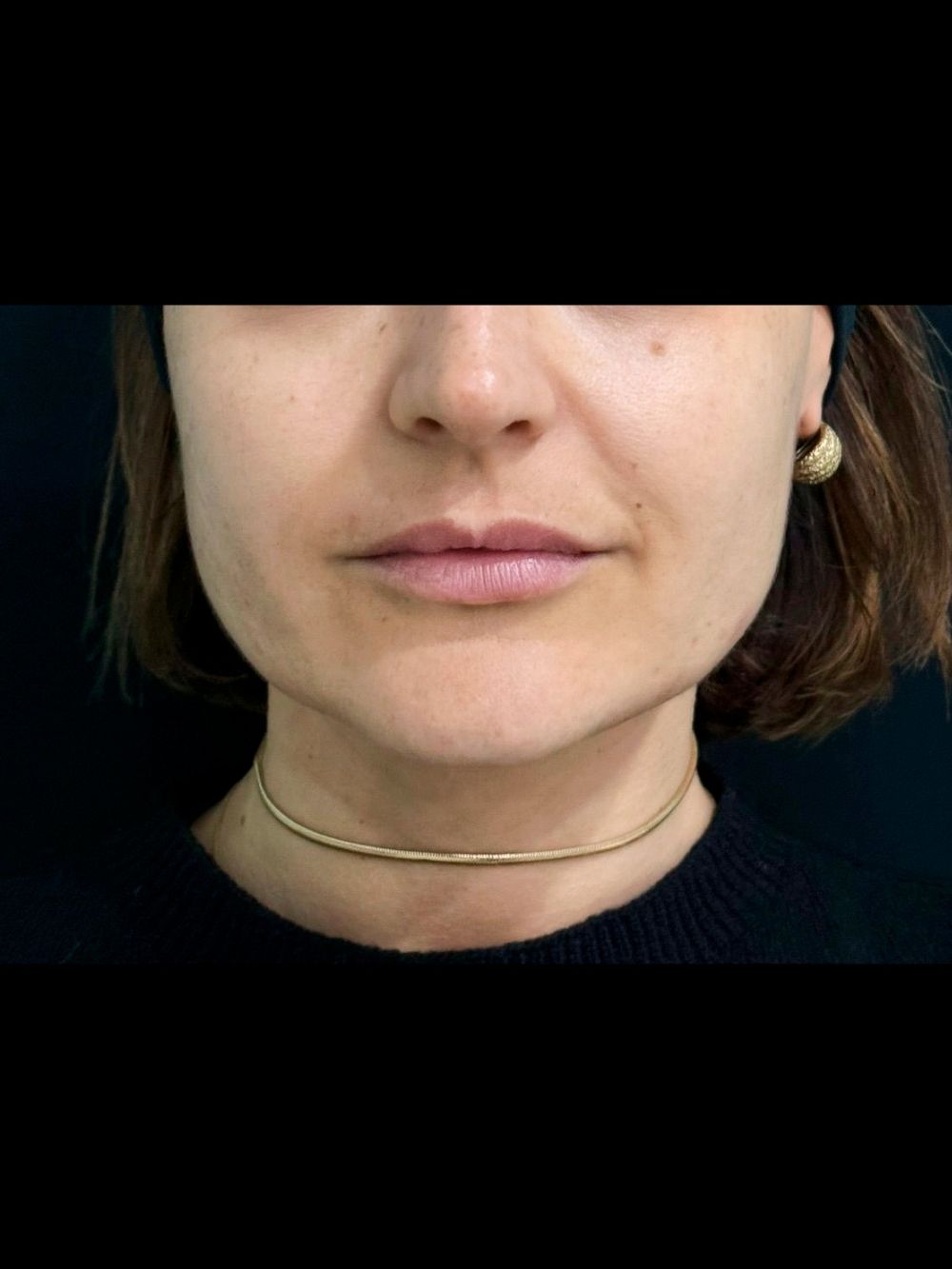 Filler labbra prima