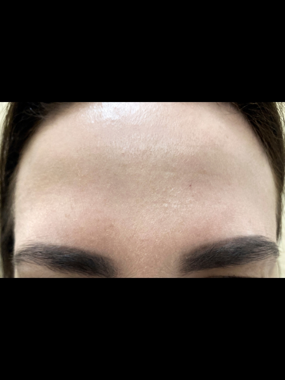 Botox dopo