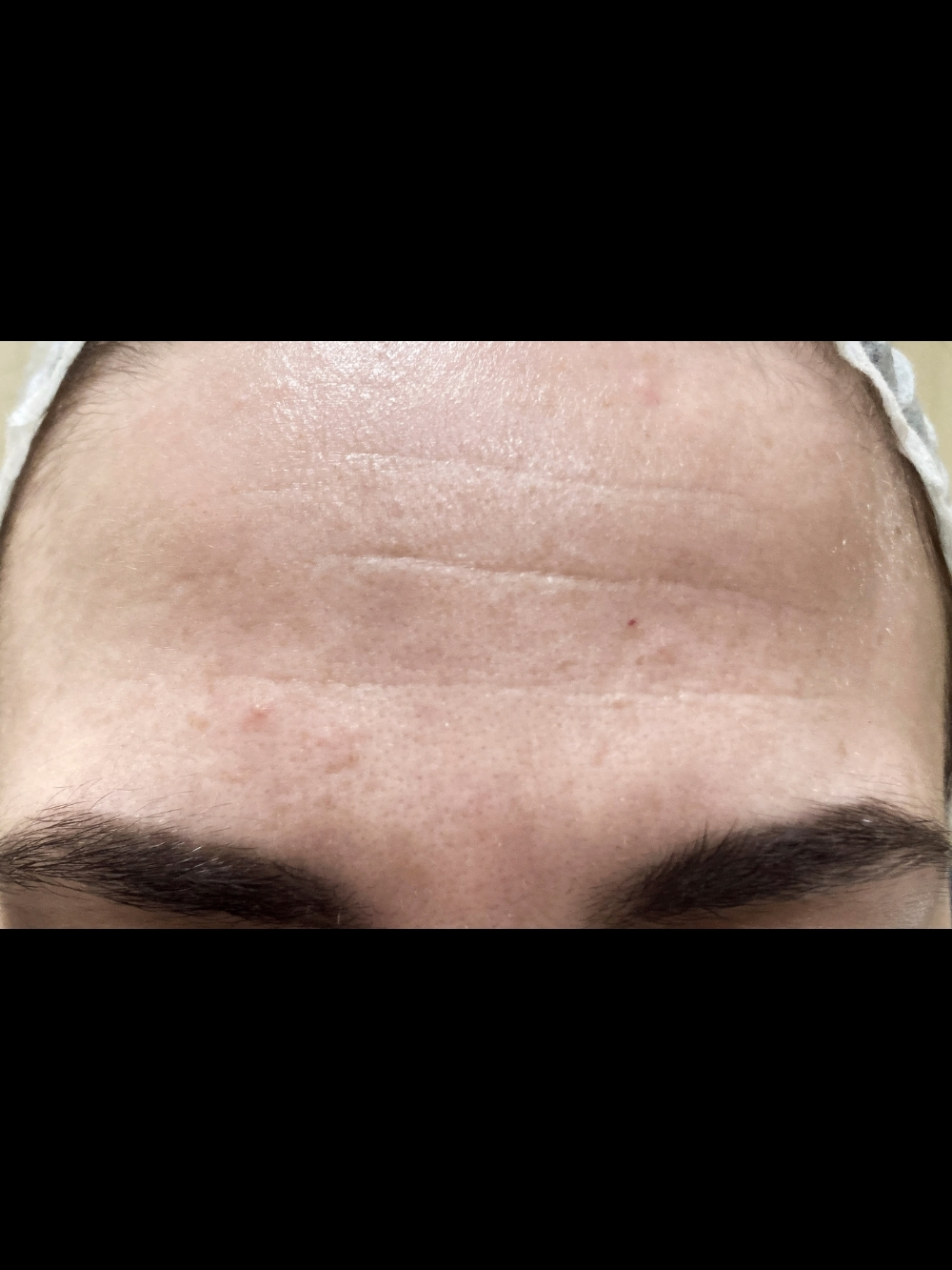 Botox prima
