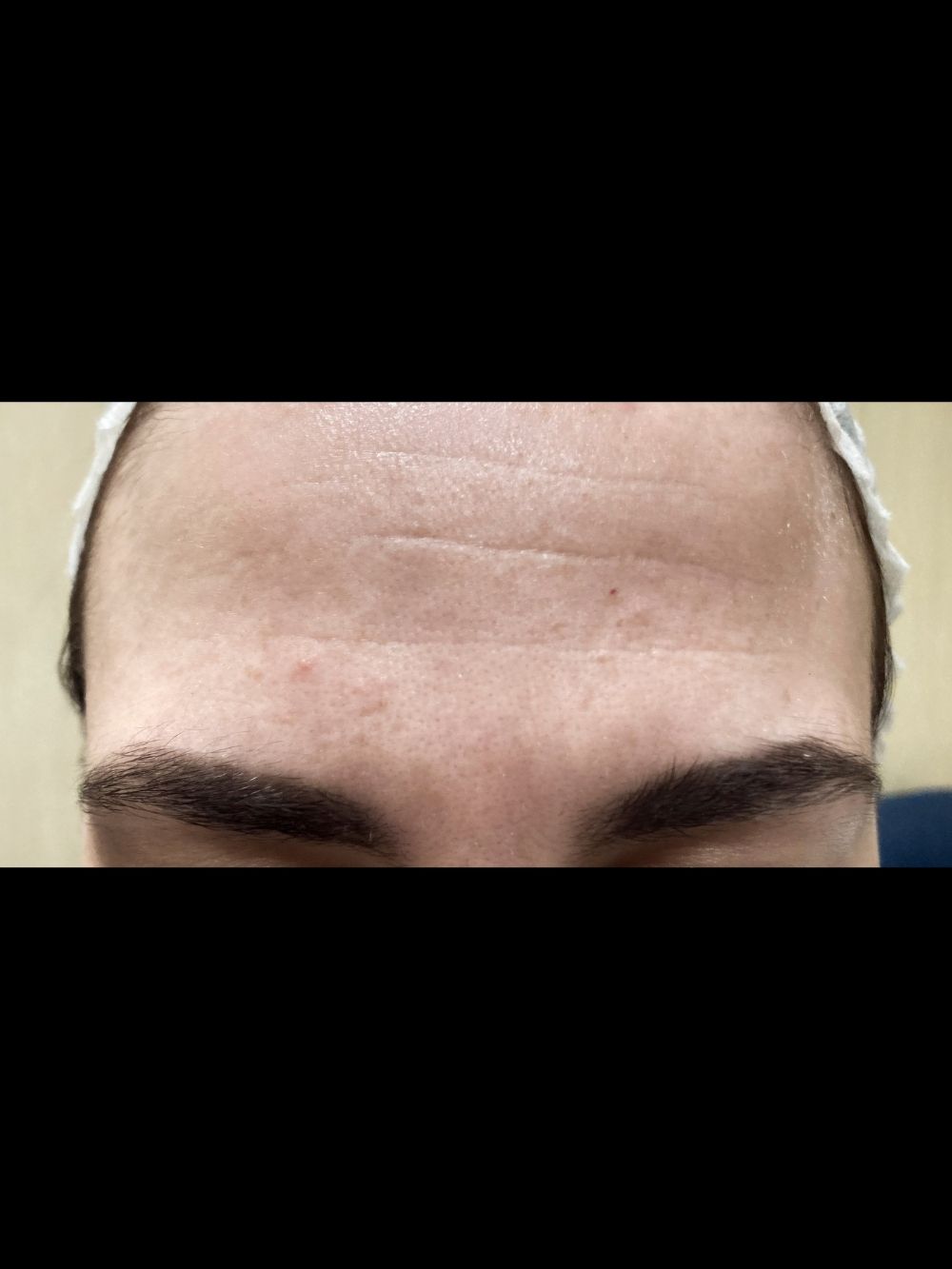 Botox prima