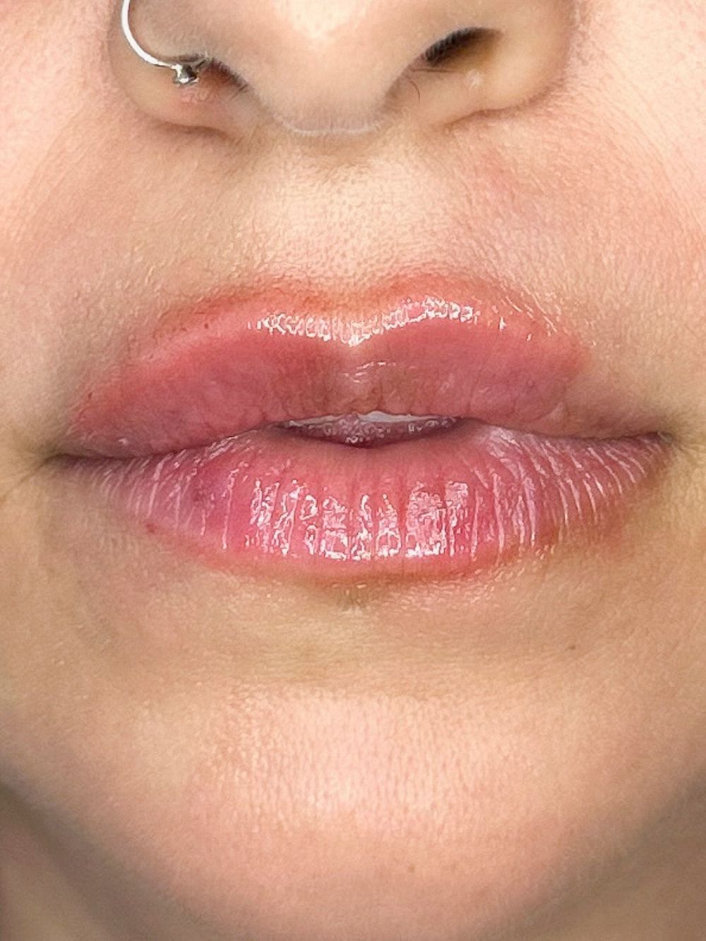 Filler labbra dopo