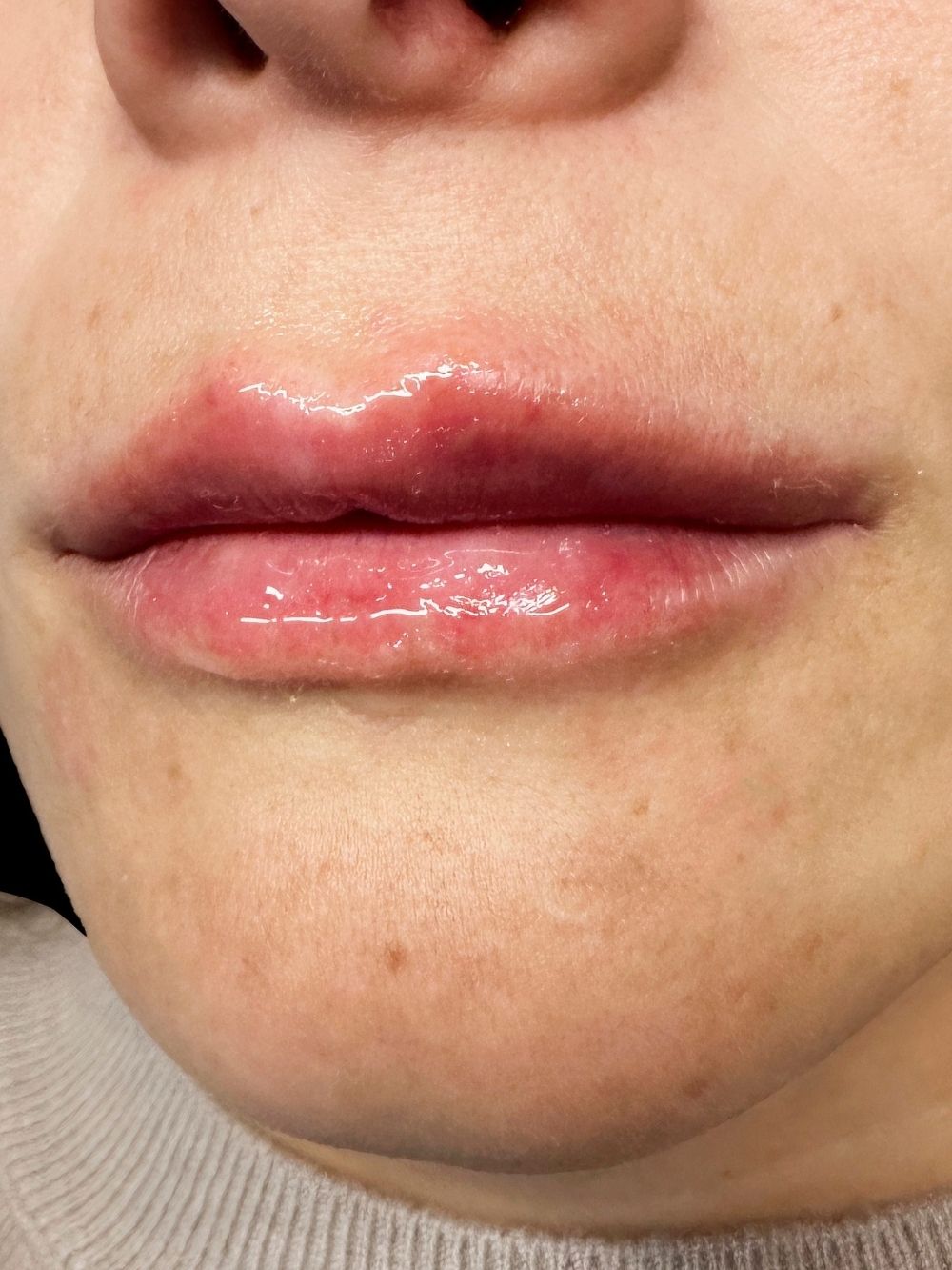 Filler labbra dopo