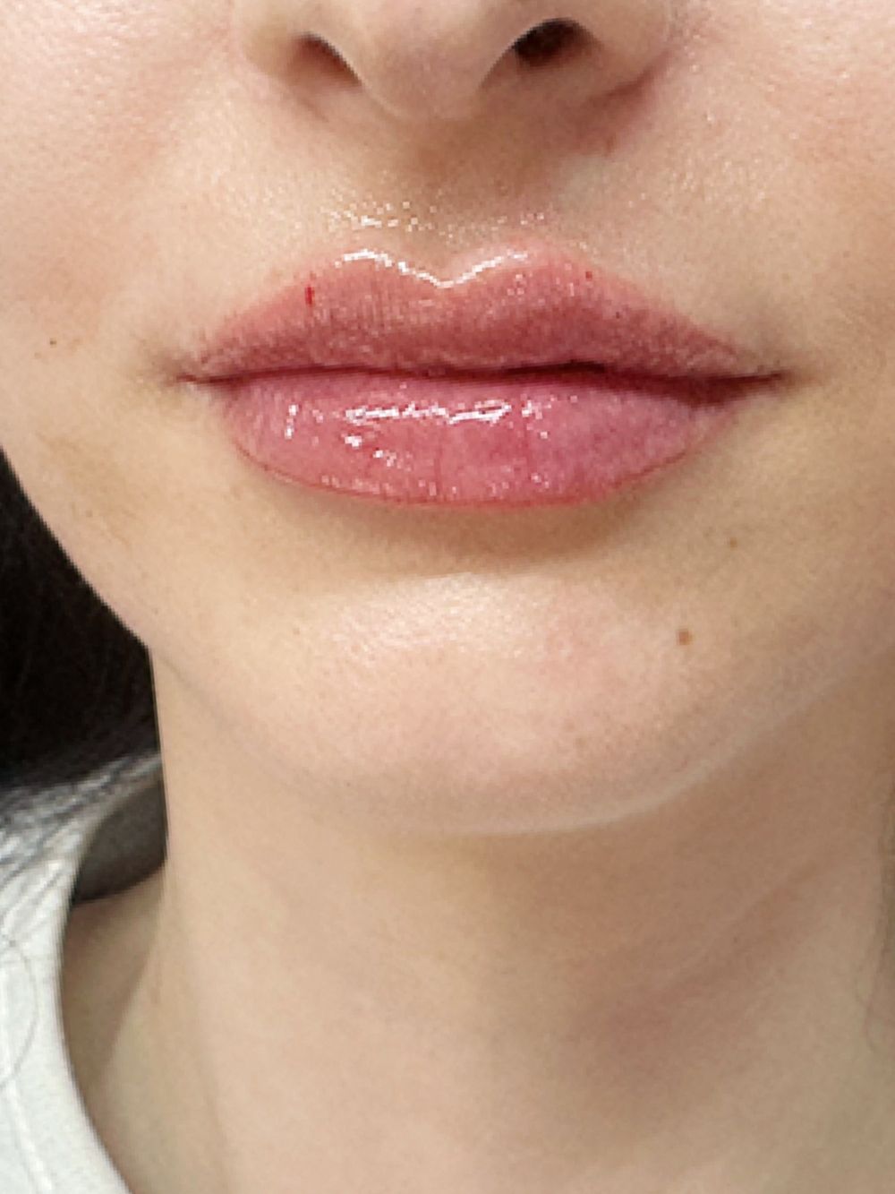 Filler labbra dopo
