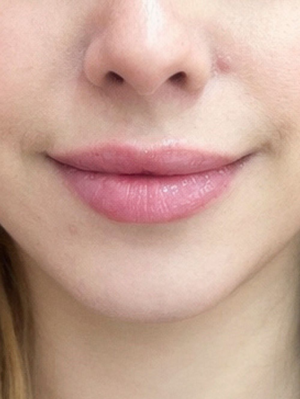 Filler labbra dopo