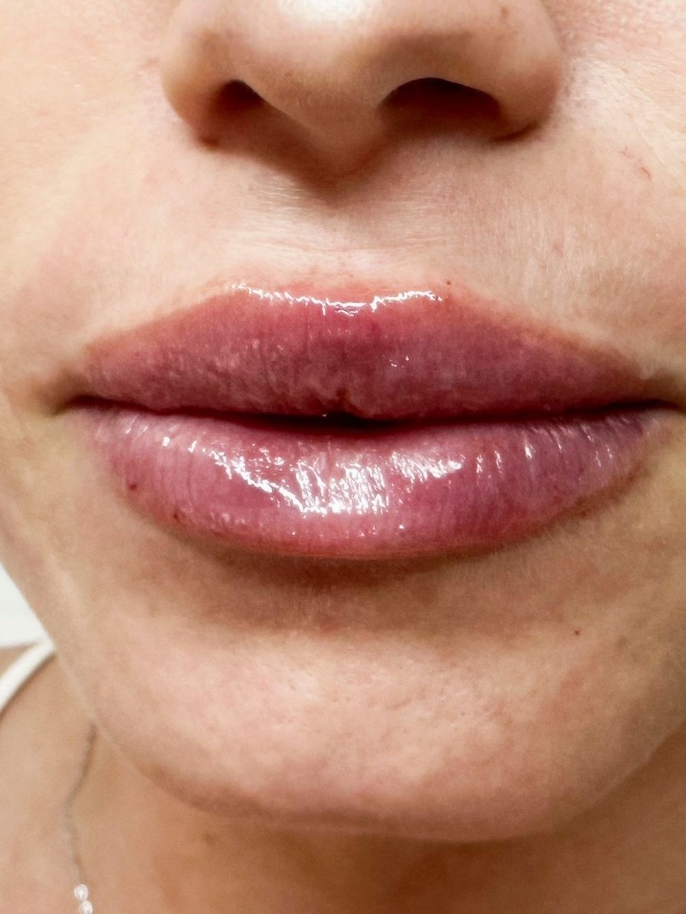 Filler labbra dopo