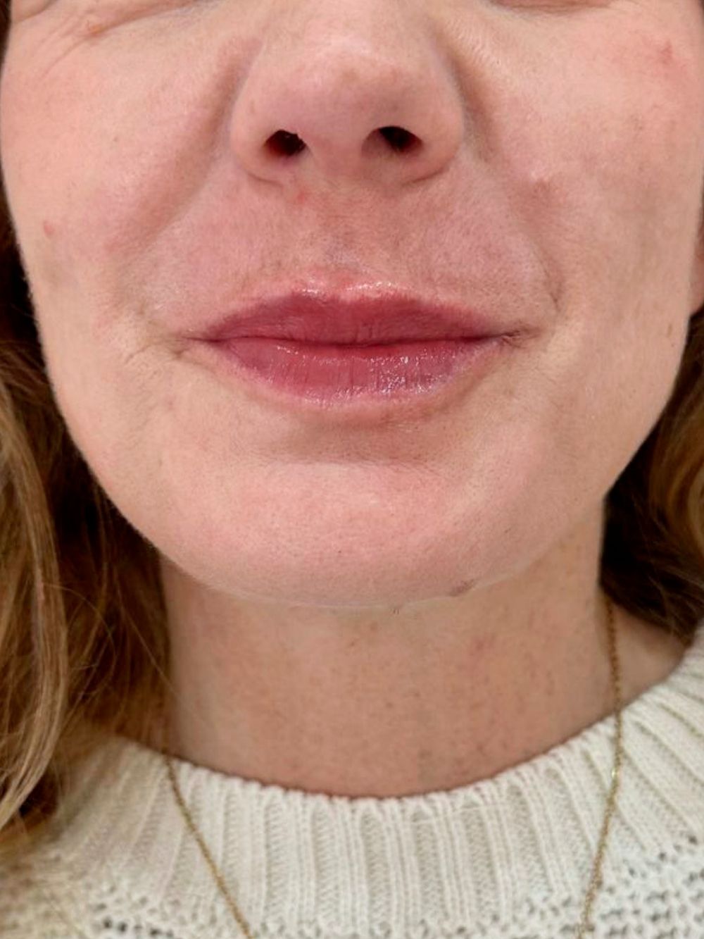 Filler labbra dopo