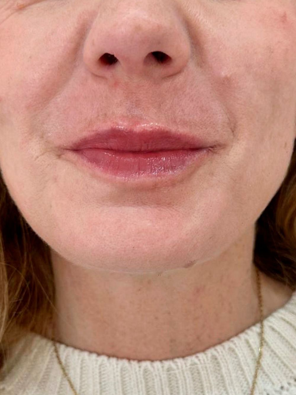 Filler labbra dopo