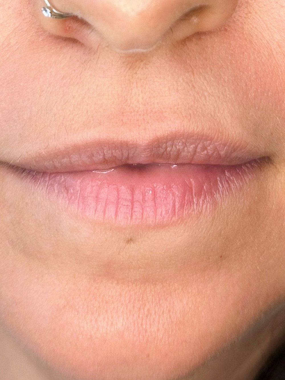 Filler labbra prima