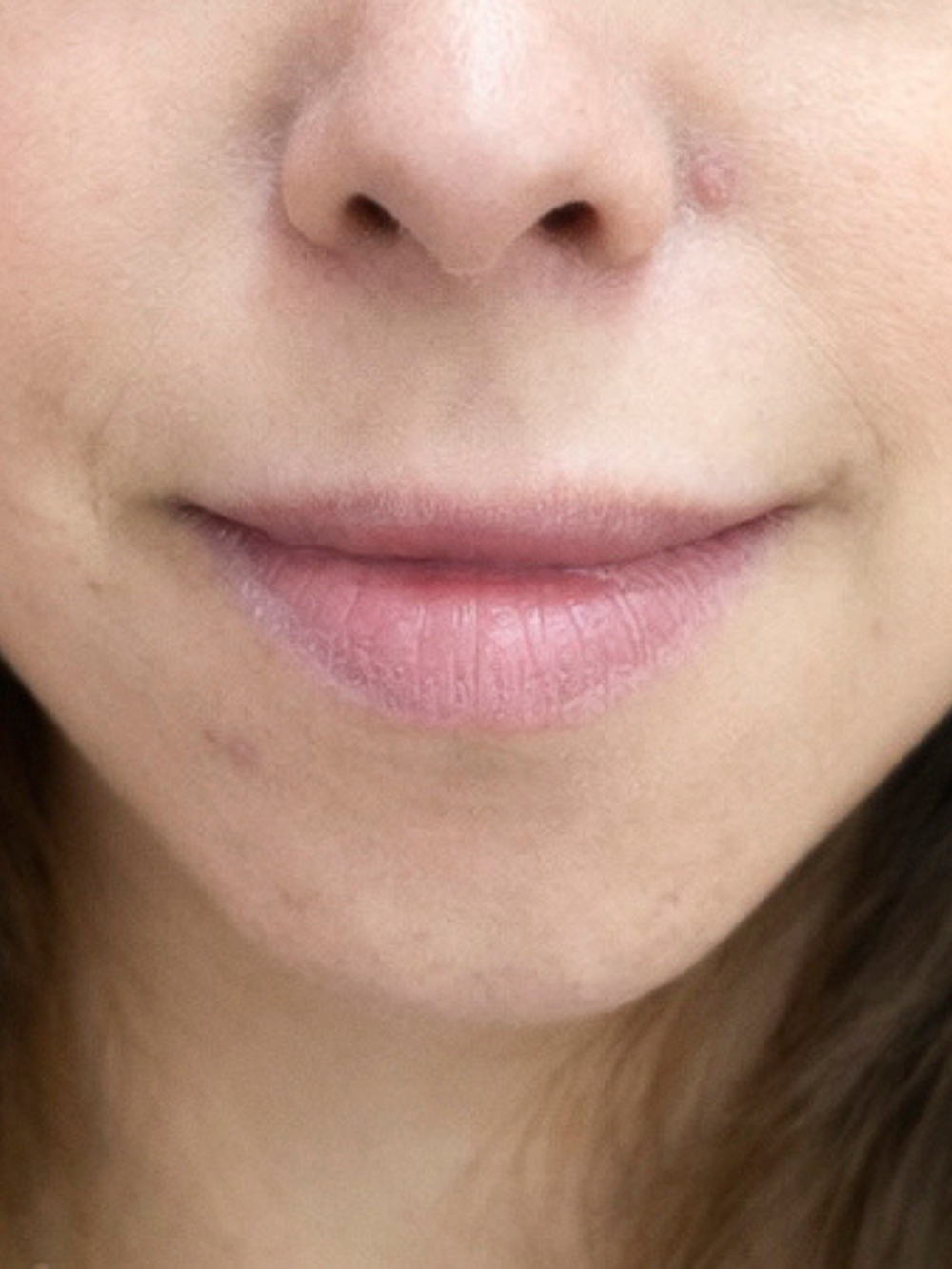 Filler labbra prima
