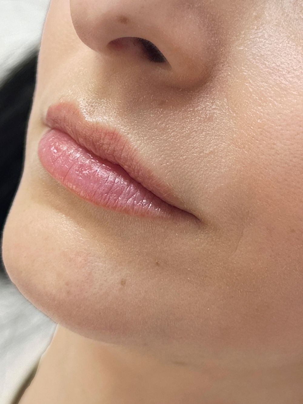 Filler labbra prima