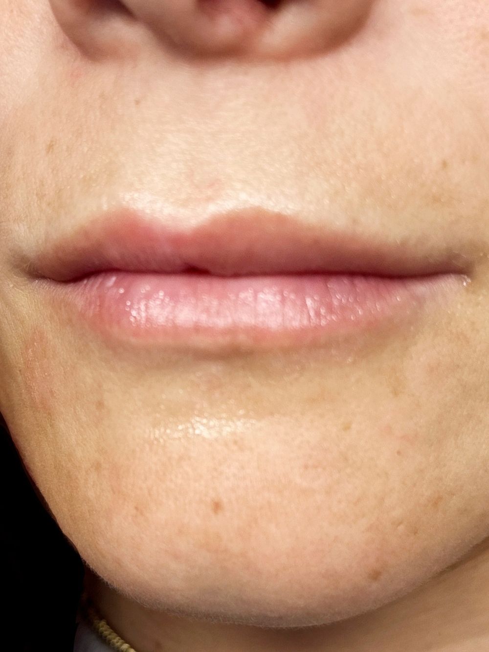 Filler labbra prima