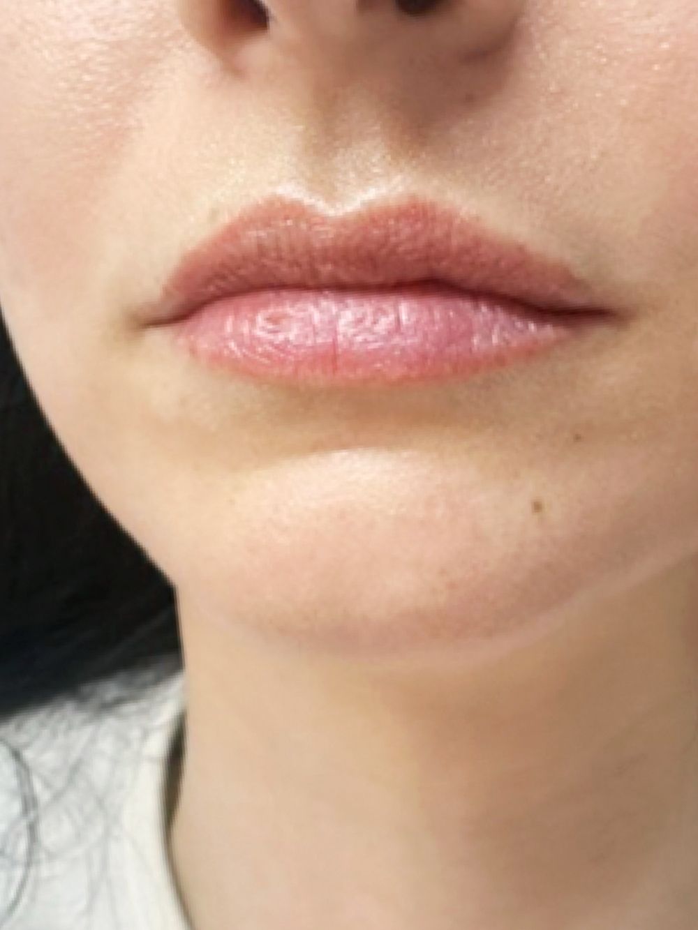 Filler labbra prima