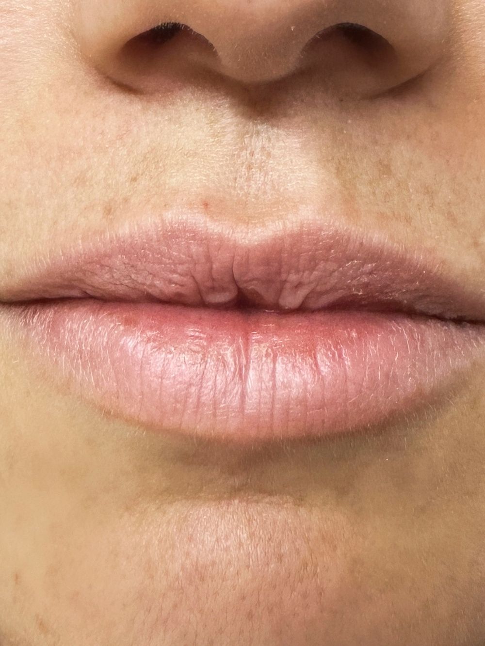 Filler labbra prima