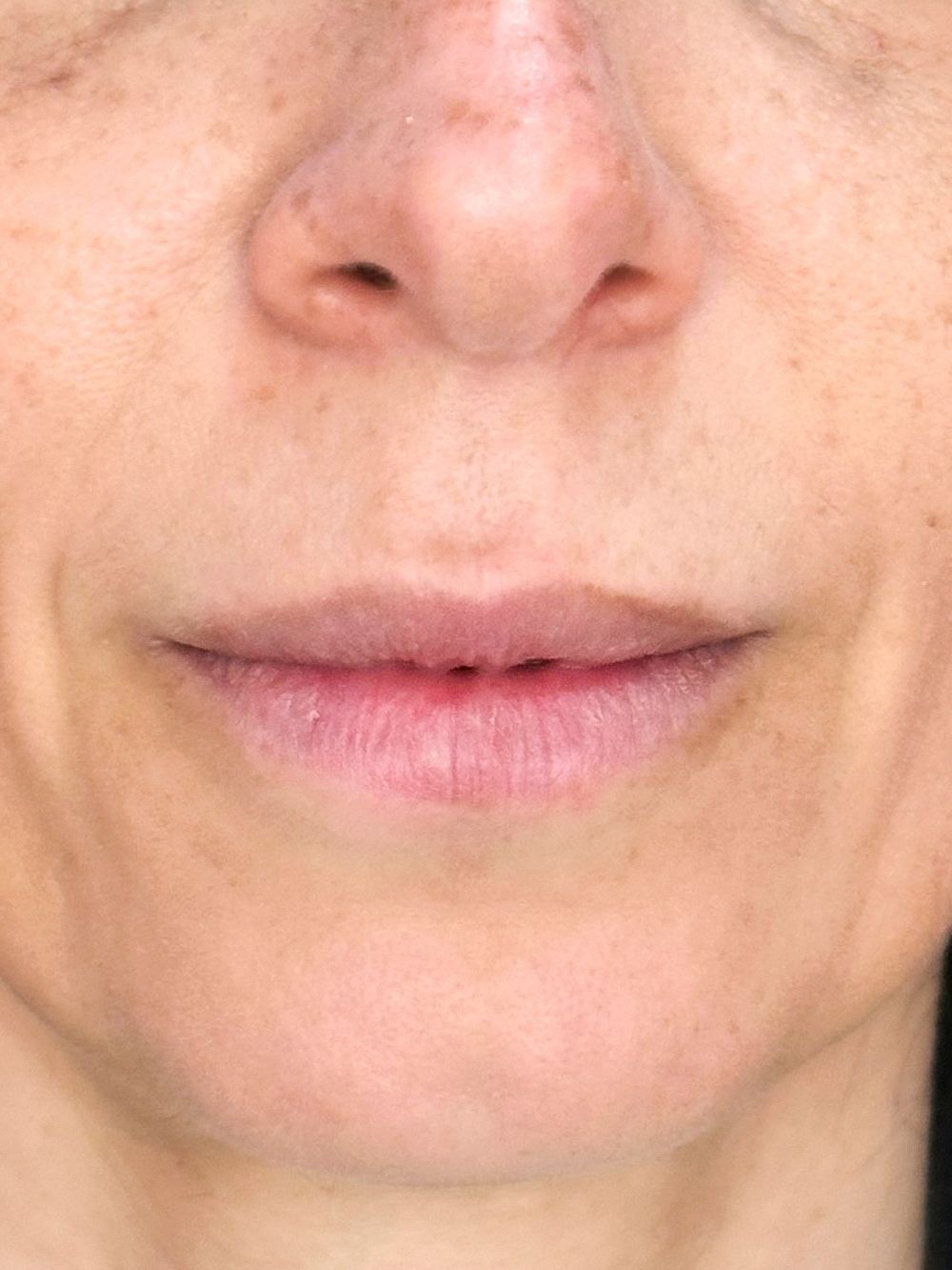 Filler labbra prima