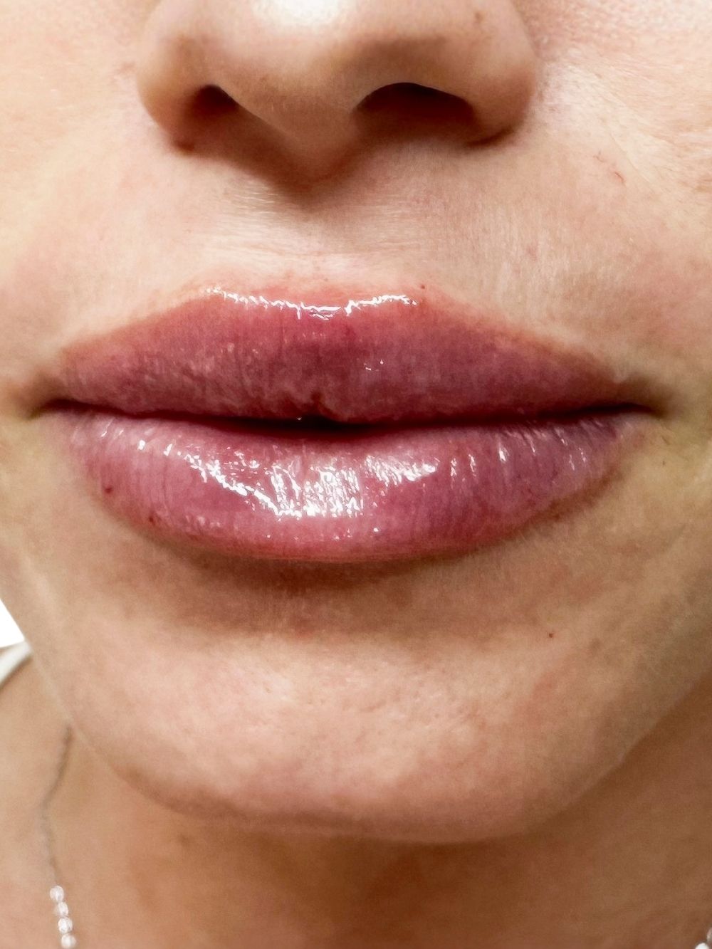 Filler labbra dopo