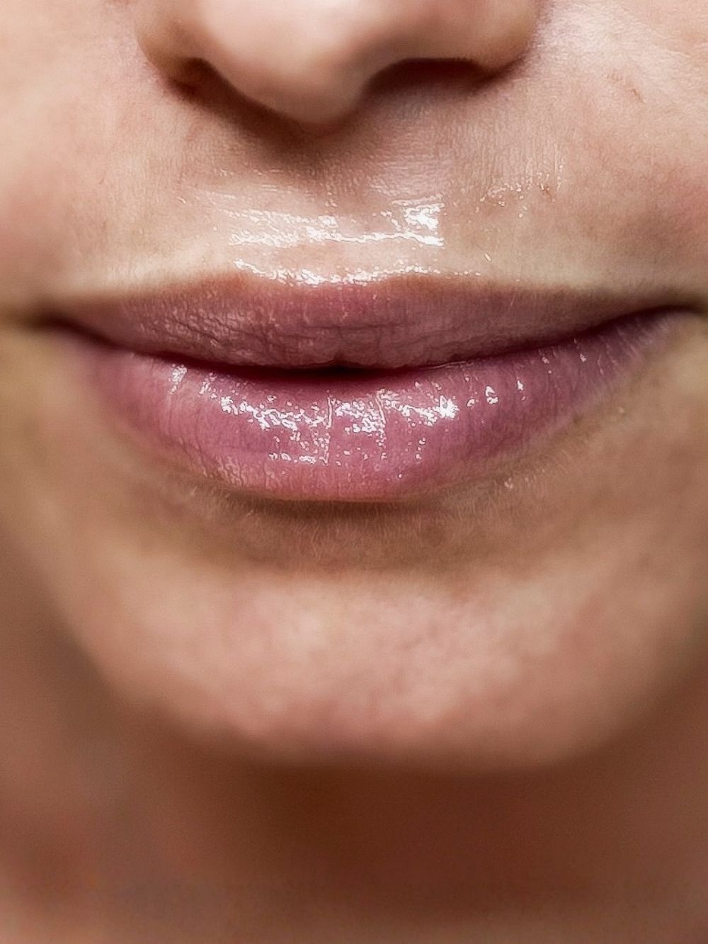 Filler labbra prima