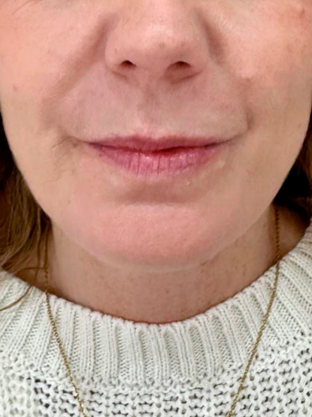 Filler labbra prima