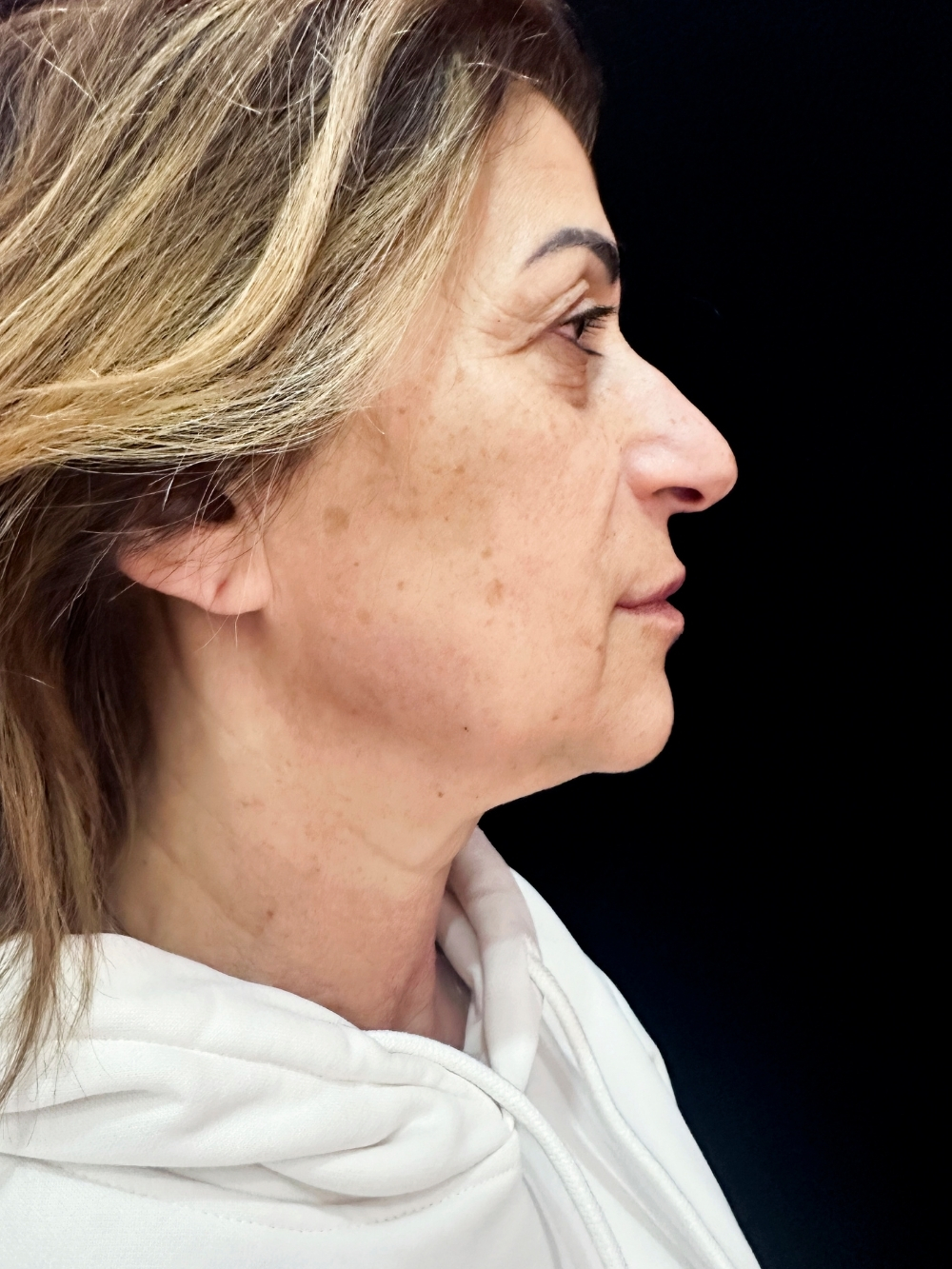 Filler mandibila dopo