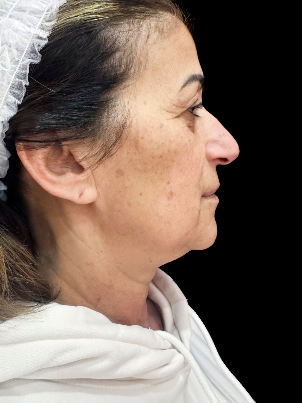 Filler mandibola prima