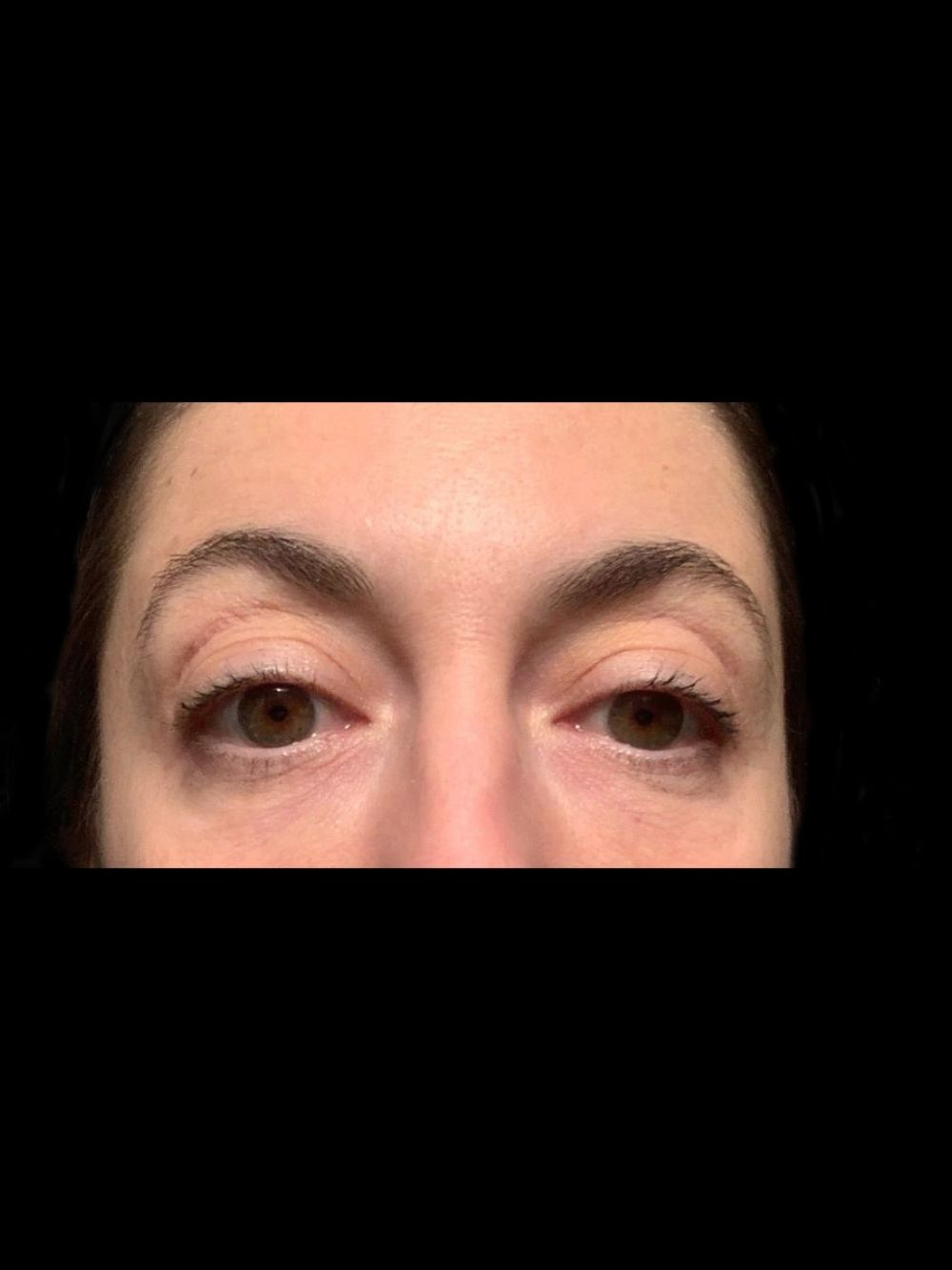 Filler perioculare dopo