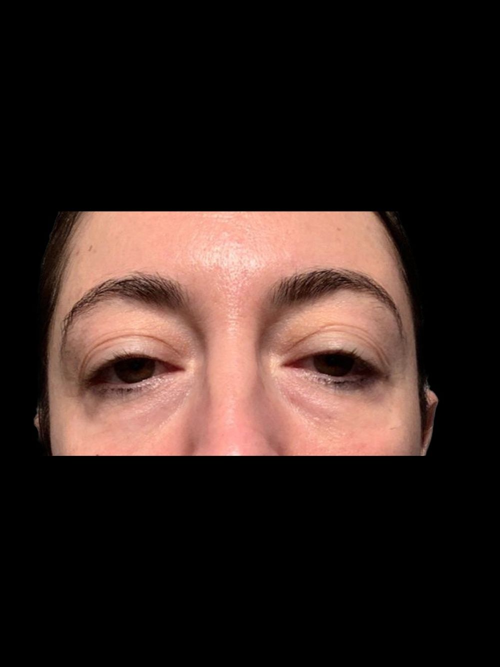 Filler perioculare prima