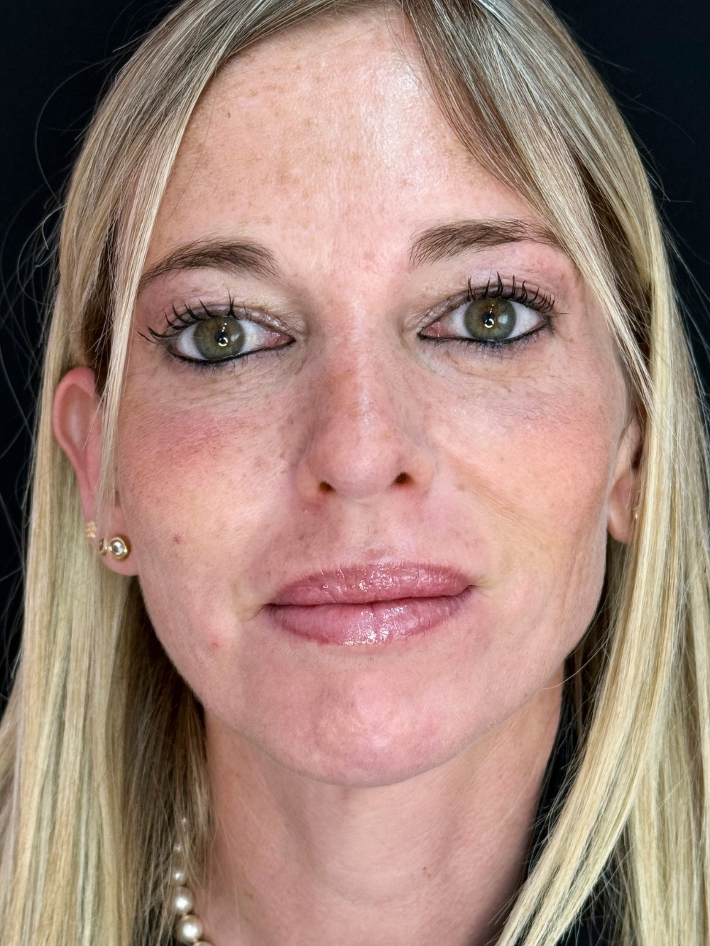 Full Face dopo